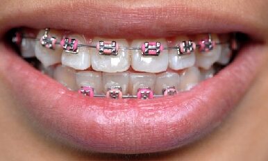 L’orthodontie : conseils pour mieux l’appréhender