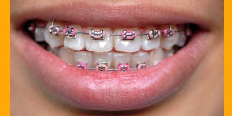 L’orthodontie : conseils pour mieux l’appréhender